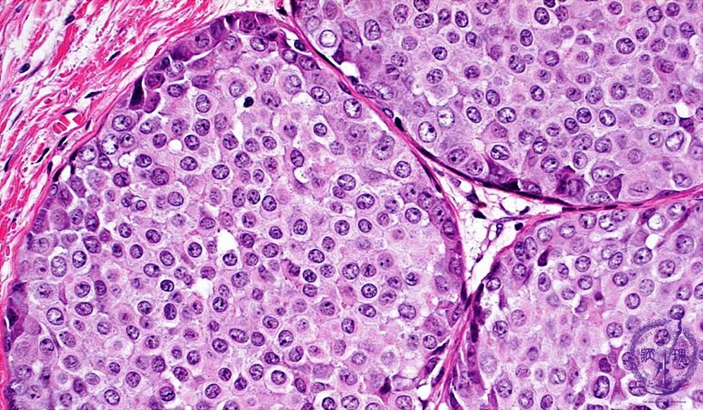 14-breast-6-invasive-ductal-carcinoma-solid-tubular-carcinoma