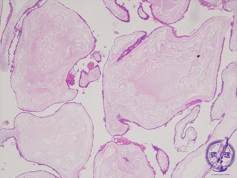 Female Genital Organs Hydatidiform Mole Complete Partial