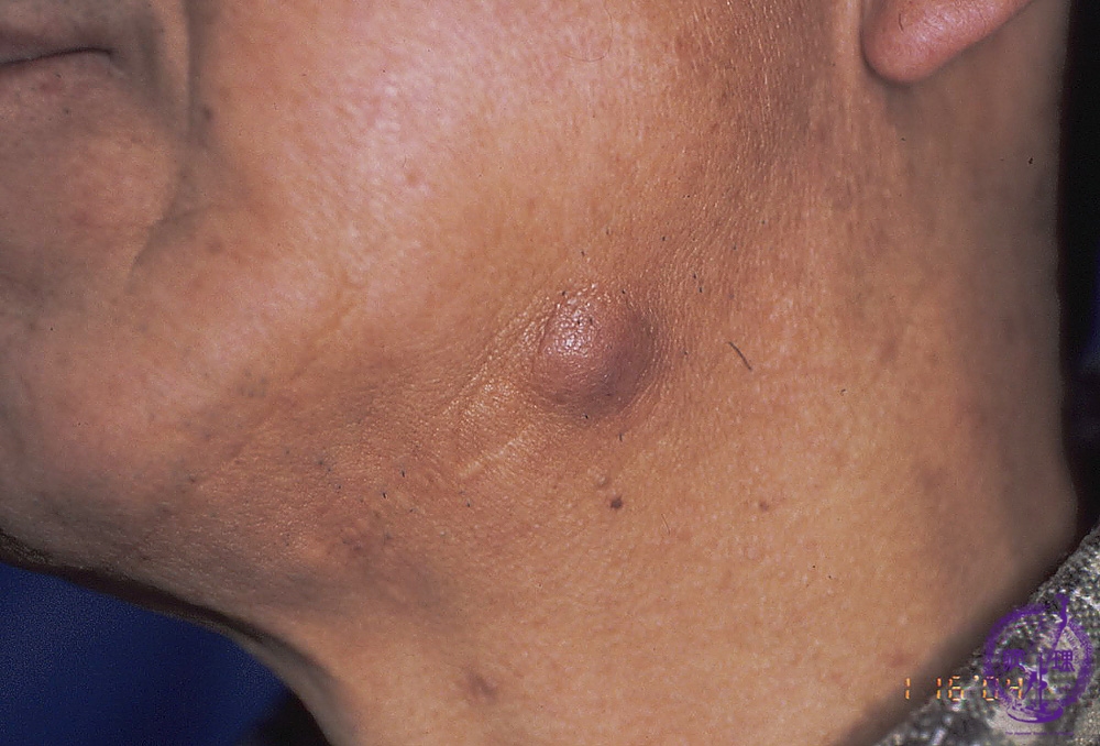 20 Skin 4 Epidermal Cyst Pathology Core Pictures